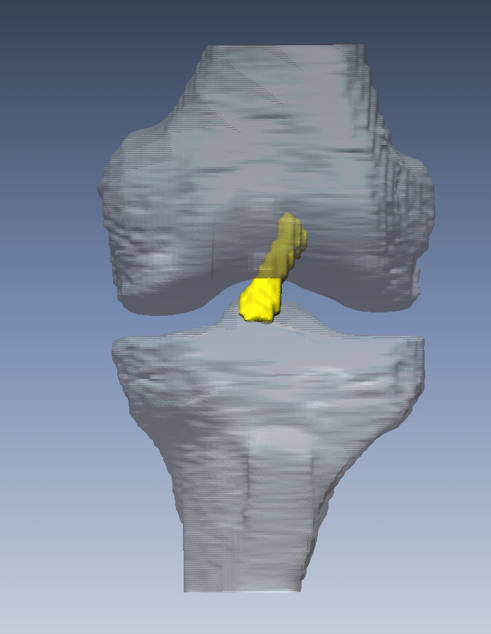 3D image of knee with ACL graft