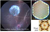 Photos of wireless retinal implants