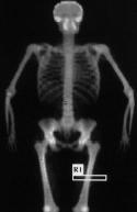 photo of bone scan