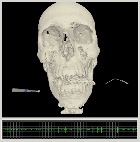 image of craniofacial surgical simulation