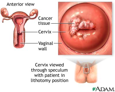 About 85% of cervical cancers