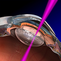 Cataract surgery with ultrafast laser.